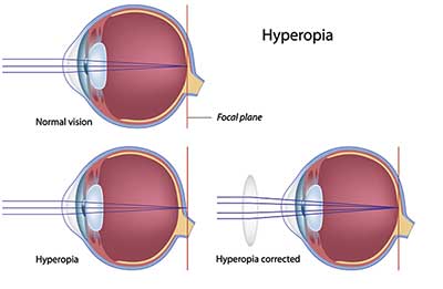 farsightedness